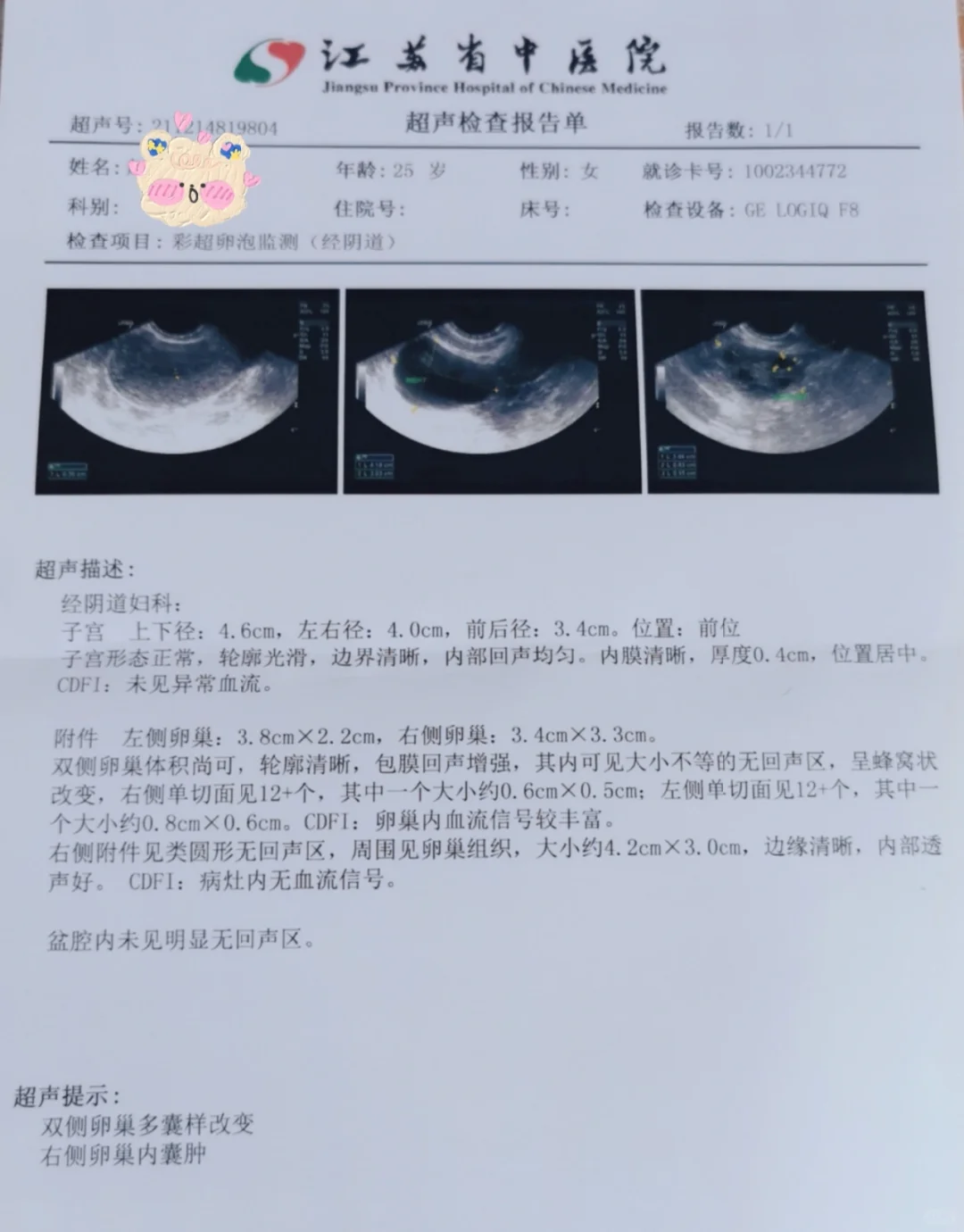 第三次排卵监测与卵泡发育异常分析